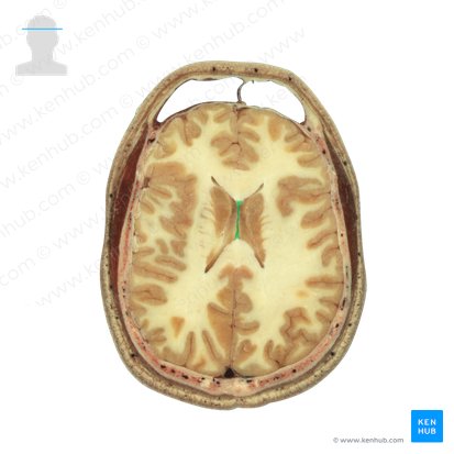 Septum pellucidum; Image: National Library of Medicine