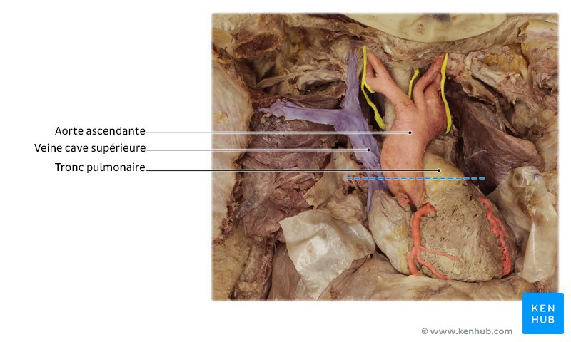 Cœur et certains de ses gros vaisseaux dans un cadavre : Autour du cœur, vous pouvez voir plusieurs couches détachées et éloignées de l'organe. Ces fines membranes représentent le péricarde. Lorsqu'il est intact, le péricarde forme un sac qui enveloppe le cœur.