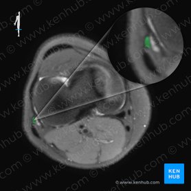 Ligamentum collaterale fibulare genus (Äußeres Kollateralband des Kniegelenks); Bild: 