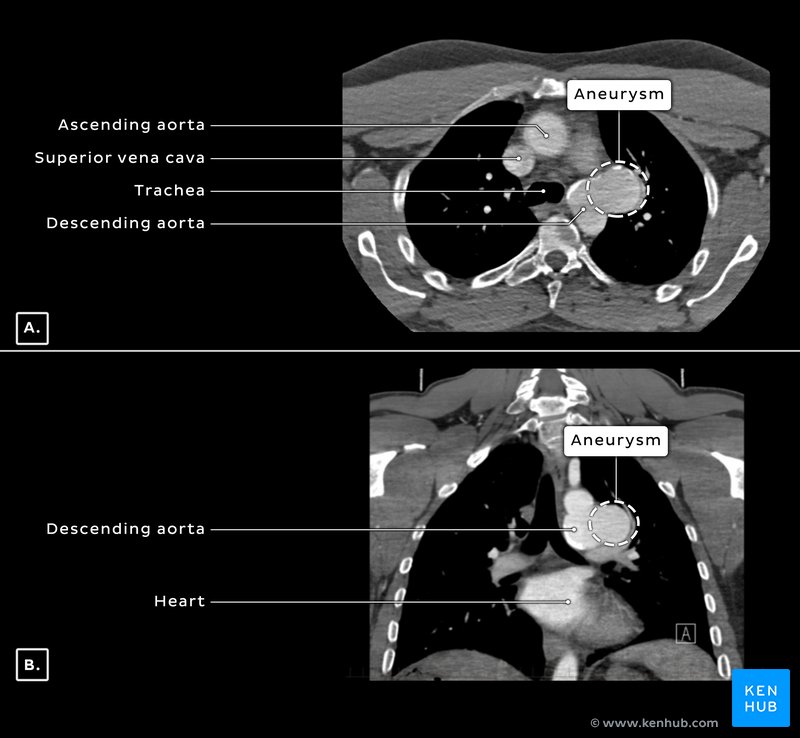 Axial CT - aortic aneurysm