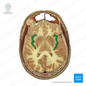 Insular lobe (Insula); Image: National Library of Medicine