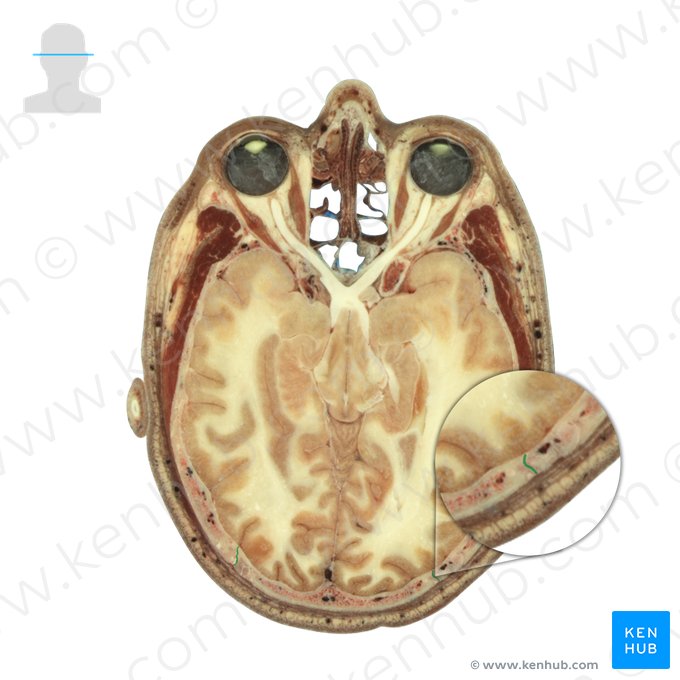 Lambdoid suture (Sutura lambdoidea); Image: National Library of Medicine