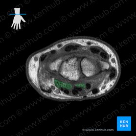 Tendons of flexor digitorum profundus muscle (Tendines musculi flexoris digitorum profundus); Image: 