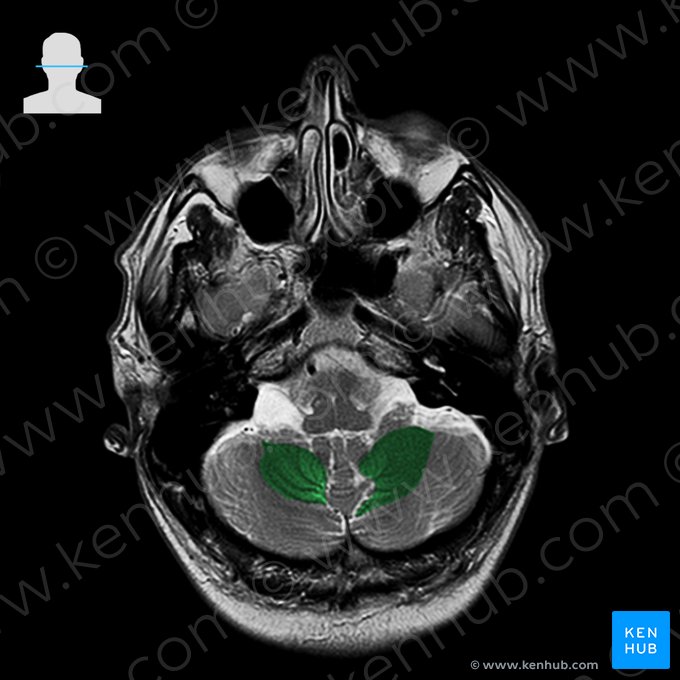 Lóbulo biventer del cerebelo (Lobulus biventer cerebelli); Imagen: 