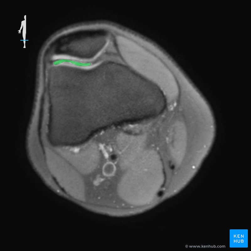 An MRI image showing fluid (with green highlight) at the level of the upper part of the patella.