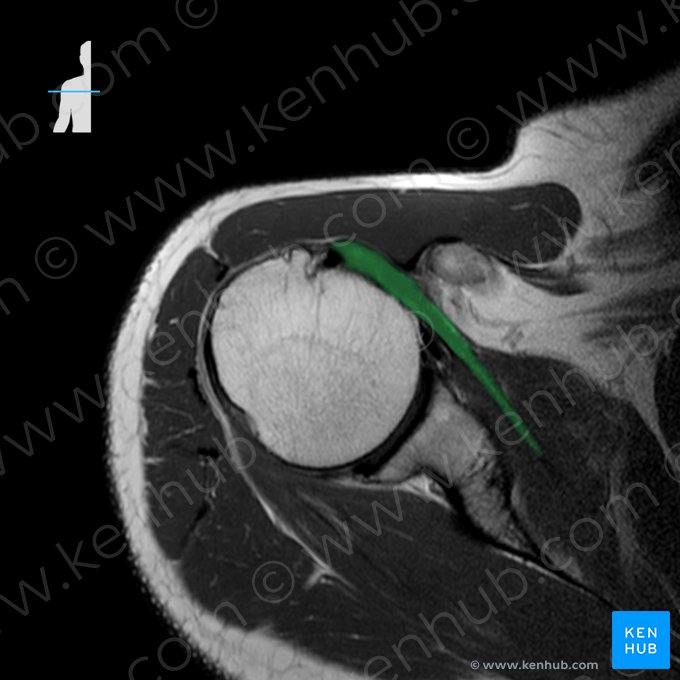 Tendón del músculo subescapular (Tendo musculi subscapularis); Imagen: 