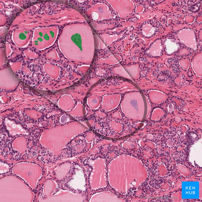 Cristais de oxalato de cálcio no folículo (Crystalla calcium oxylatorum folliculi); Imagem: 