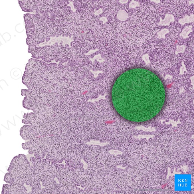 Stromal edema; Image: 