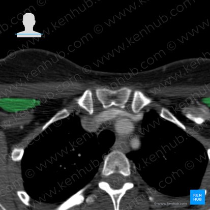 Pectoralis minor muscle (Musculus pectoralis minor); Image: 