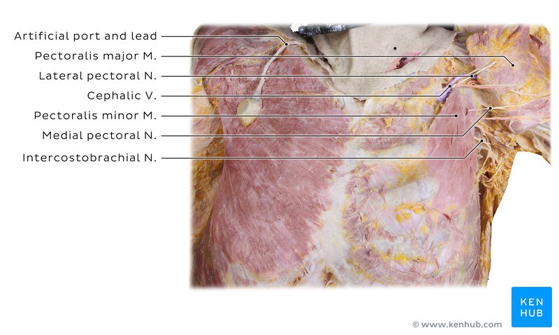 Pectoralis minor in a cadaver