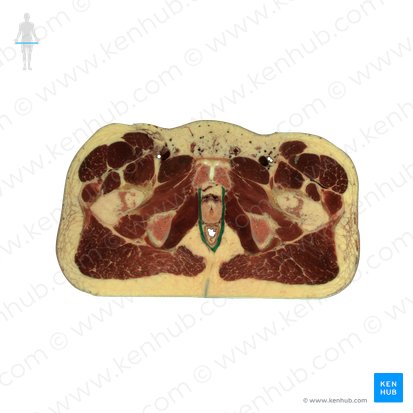 Musculus puborectalis (Schambein-Mastdarm-Muskel); Bild: National Library of Medicine