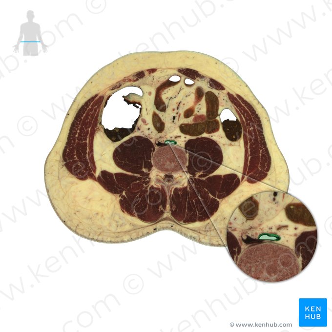 Aorta abdominal (Aorta abdominalis); Imagem: National Library of Medicine