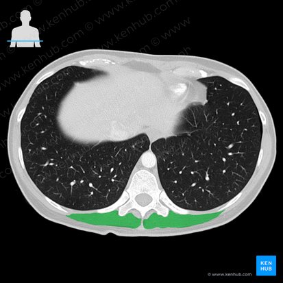 Músculo erector de la columna (Musculus erector spinae); Imagen: 