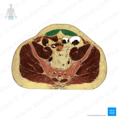 Musculus rectus abdominis (Gerader Bauchmuskel); Bild: National Library of Medicine