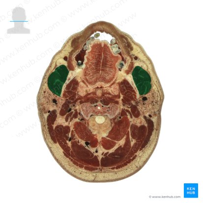 Masseter muscle (Musculus masseter); Image: National Library of Medicine