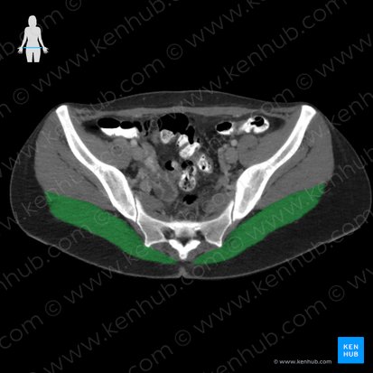 Musculus gluteus maximus (Großer Gesäßmuskel); Bild: 