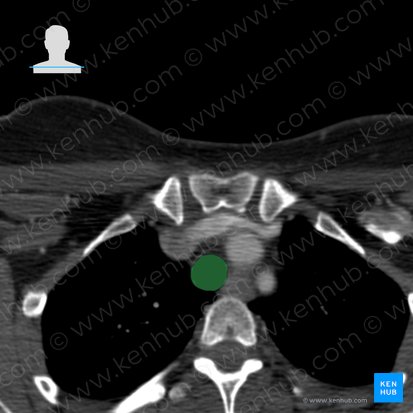 Tráquea (Trachea); Imagen: 