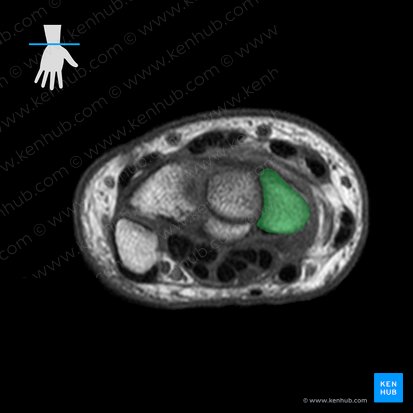 Scaphoid bone (Os scaphoideum); Image: 