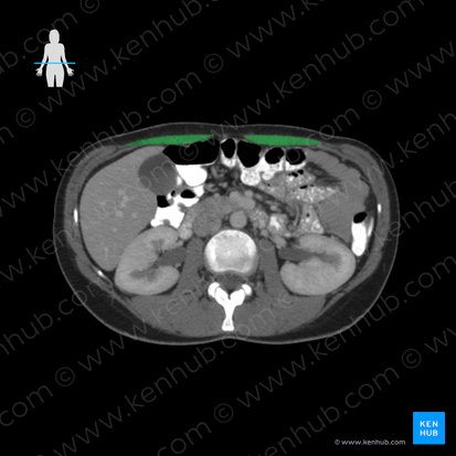 Musculus rectus abdominis (Gerader Bauchmuskel); Bild: 