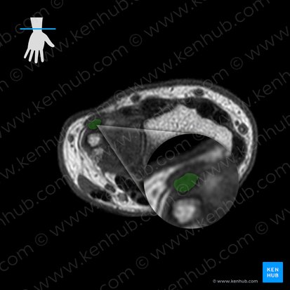 Tendon of extensor carpi ulnaris muscle (Tendo musculi extensoris carpi ulnaris); Image: 