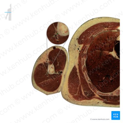 Nervus radialis (Speichennerv); Bild: National Library of Medicine