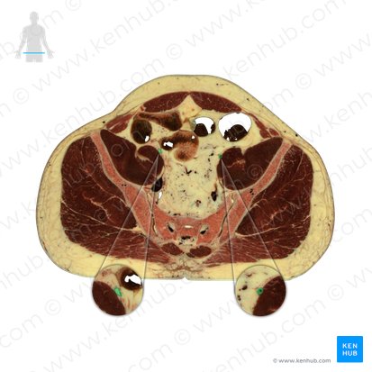 External iliac artery (Arteria iliaca externa); Image: National Library of Medicine