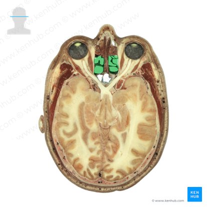 Células etmoidais (Cellulae ethmoidales); Imagem: National Library of Medicine