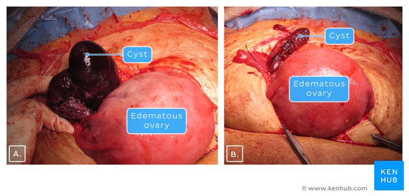 Edematous ovary and cyst