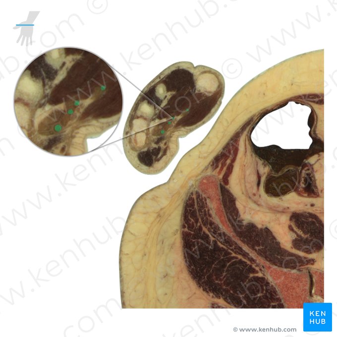 Tendons of flexor digitorum superficialis muscle (Tendines musculi flexoris digitorum superficialis); Image: National Library of Medicine