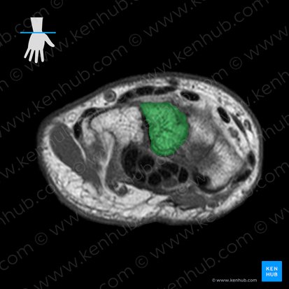 Capitate bone (Os capitatum); Image: 