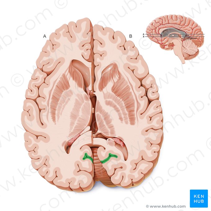 Sulco calcarino (Sulcus calcarinus); Imagem: Paul Kim