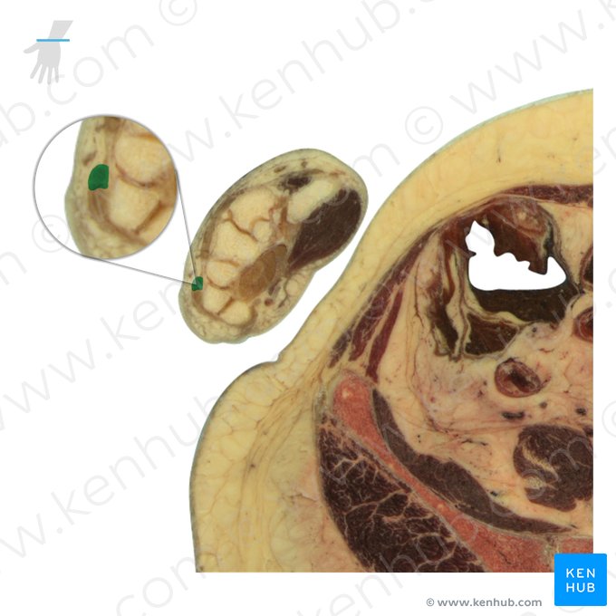 Tendão do músculo extensor do dedo mínimo (Tendo musculi extensoris digiti minimi); Imagem: National Library of Medicine