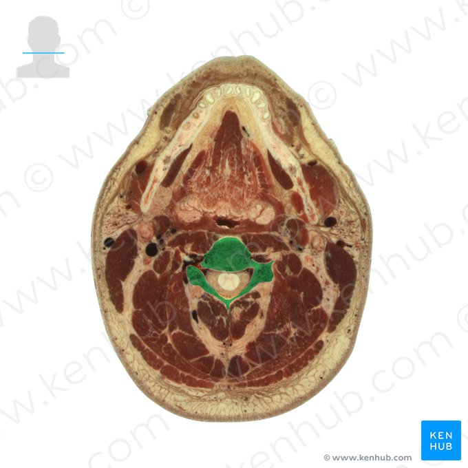 Vertebra C3 (Wirbel C3); Bild: National Library of Medicine