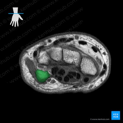 Pisiform bone (Os pisiforme); Image: 