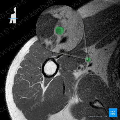 Arteria brachialis (Oberarmarterie); Bild: 