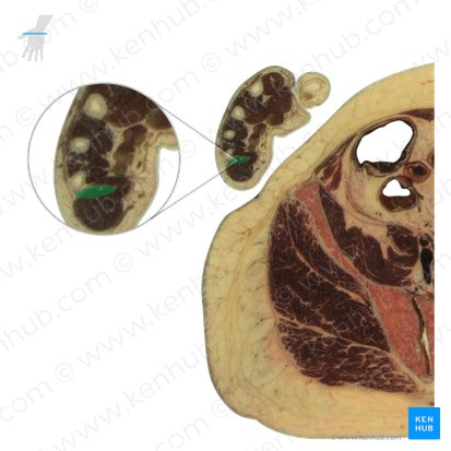 Opponens digiti minimi muscle of hand (Musculus opponens digiti minimi manus); Image: National Library of Medicine