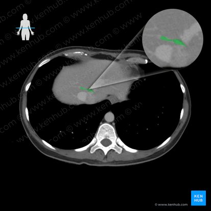 Intermediate hepatic vein (Vena hepatica intermedia); Image: 