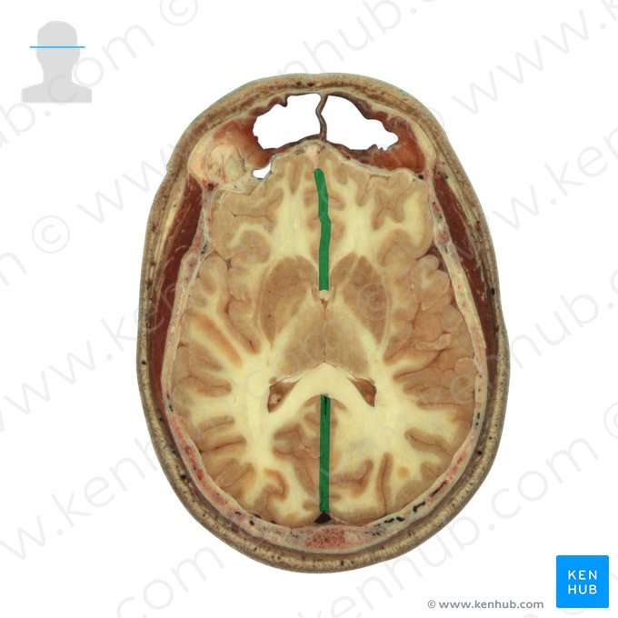 Fissura longitudinal do cérebro (Fissura longitudinalis cerebri); Imagem: National Library of Medicine