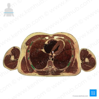 External intercostal muscles (Musculi intercostales externi); Image: National Library of Medicine