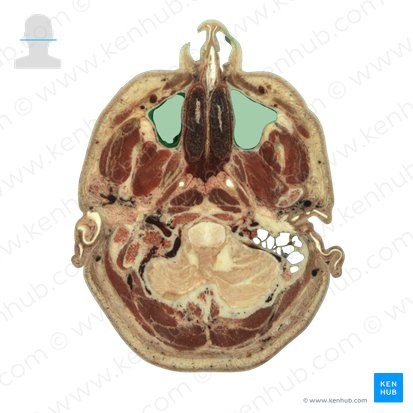 Sinus maxillaris (Kieferhöhle); Bild: National Library of Medicine