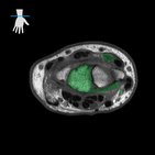 MRI of the wrist: normal anatomy