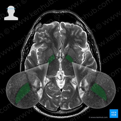 Globus pallidus (Blasser Kern); Bild: 