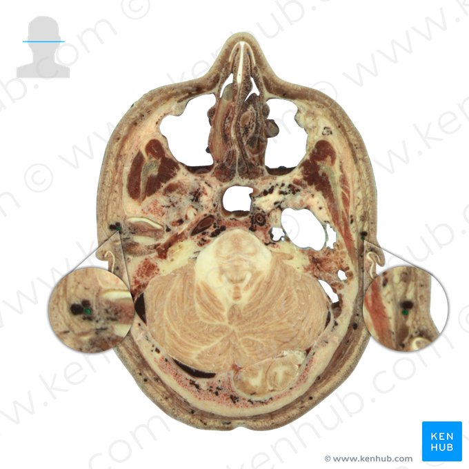 Artéria temporal superficial (Arteria temporalis superficialis); Imagem: National Library of Medicine