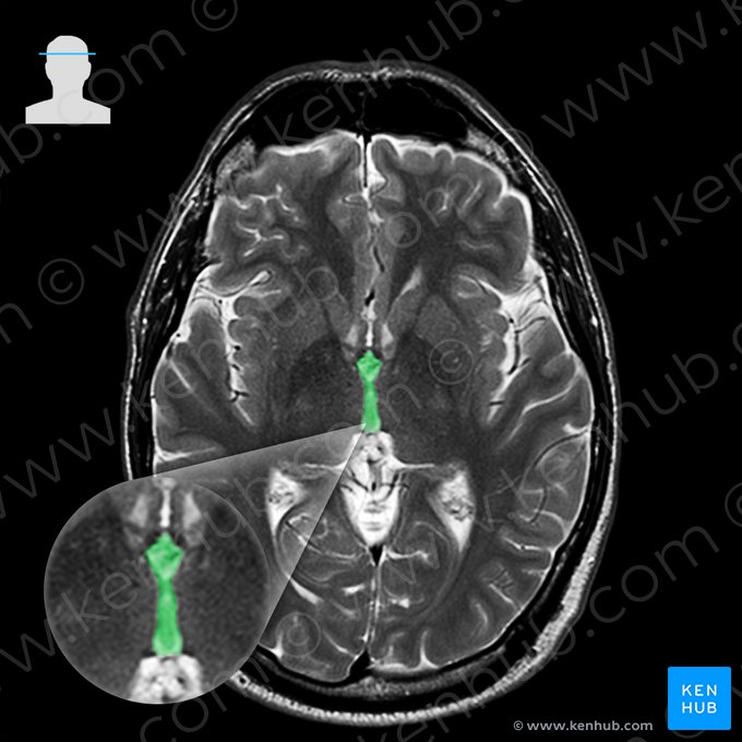 Tercer ventrículo (Ventriculus tertius); Imagen: 