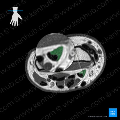 Flexor pollicis longus muscle (Musculus flexor pollicis longus); Image: 