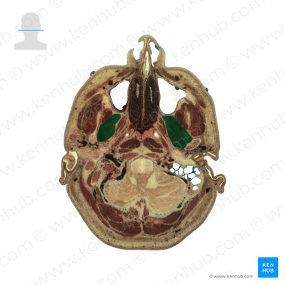 Músculo pterigoideo lateral (Musculus pterygoideus lateralis); Imagen: National Library of Medicine