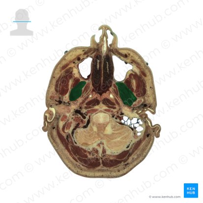 Lateral pterygoid muscle (Musculus pterygoideus lateralis); Image: National Library of Medicine