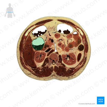 Ascending colon (Colon ascendens); Image: National Library of Medicine