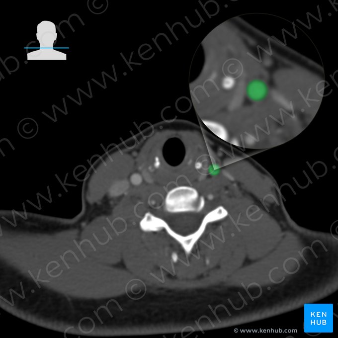 Left common carotid artery (Arteria carotis communis sinistra); Image: 