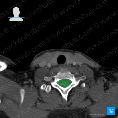 Vertebral canal (Canalis vertebralis); Image: 